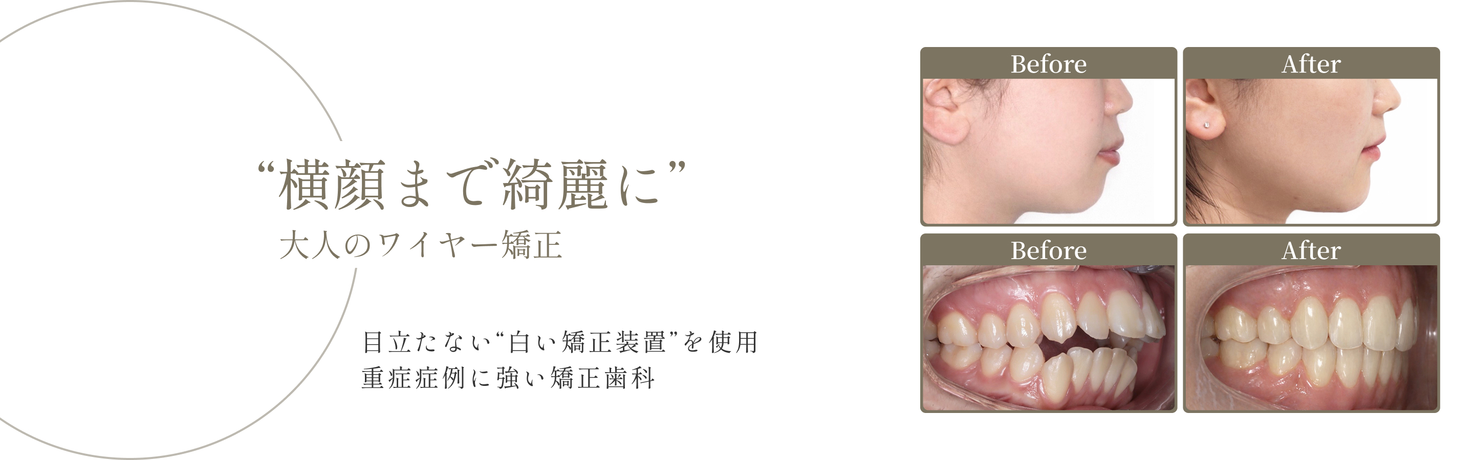 大人の矯正歯科