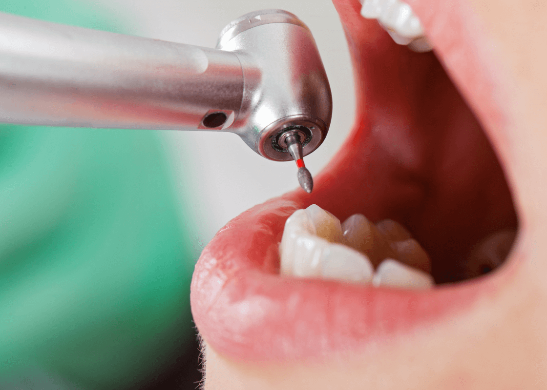 虫歯治療について