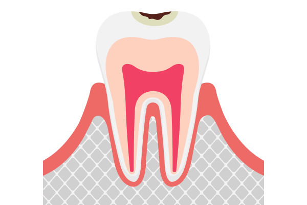 C1 (エナメル質)