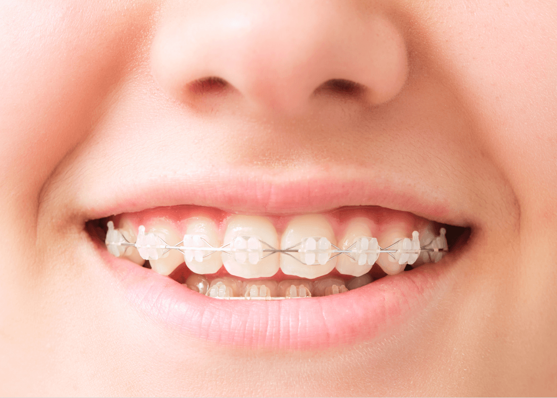 お子さまの矯正治療について