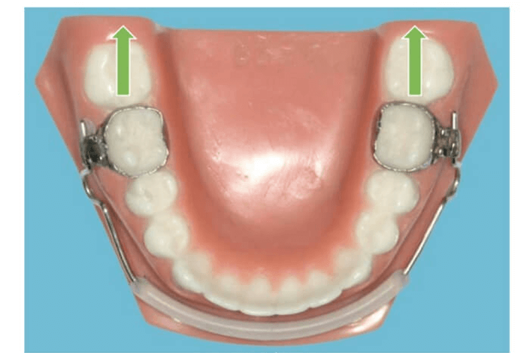 バイオネーター