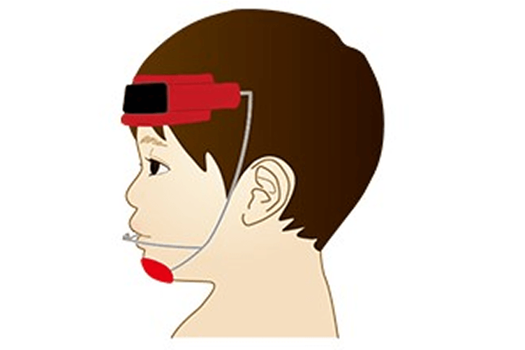 上顎前方牽引装置